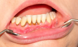 How To Remove Tartar From Teeth Naturally