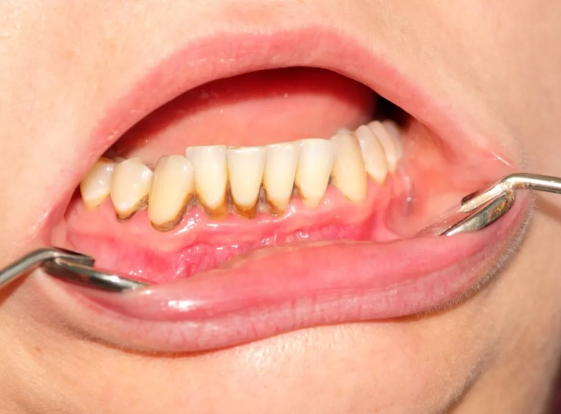 How to remove tartar from teeth naturally