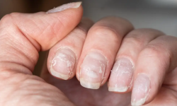 Why Do I Get Lines On My Nails And How To Remove Them?