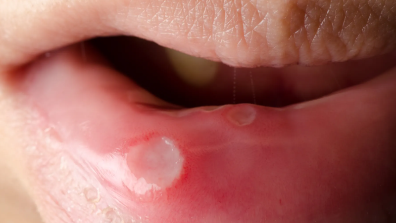 How To Cure Mouth Sores With Home Remedies