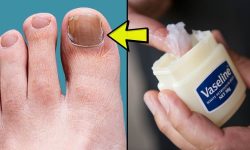 Remedies To Eliminate Nail Fungus: Myths And Truths