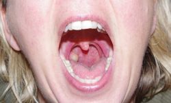 What To Do To Treat Throat Pus?