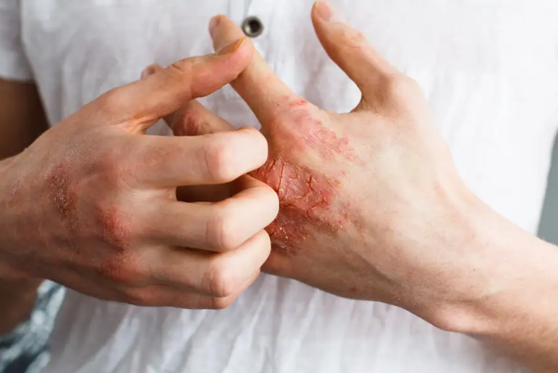 Pustular psoriasis