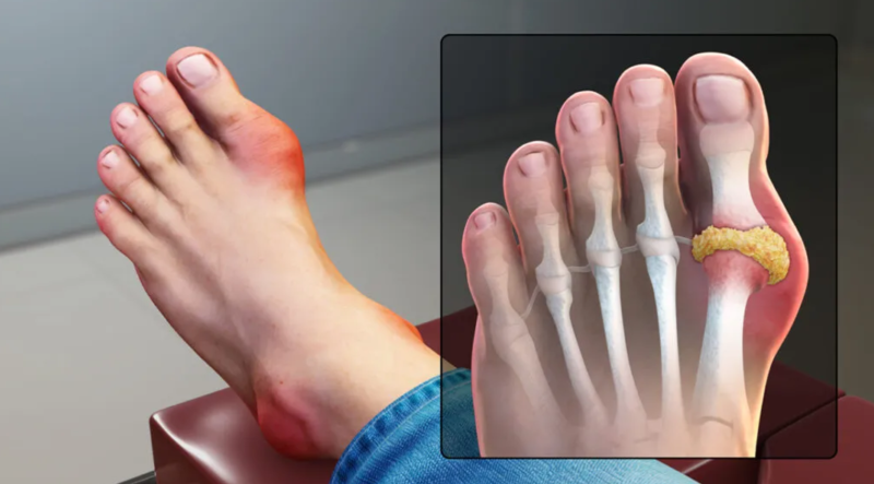 9 Diseases That Cause Pain In The Big Toe