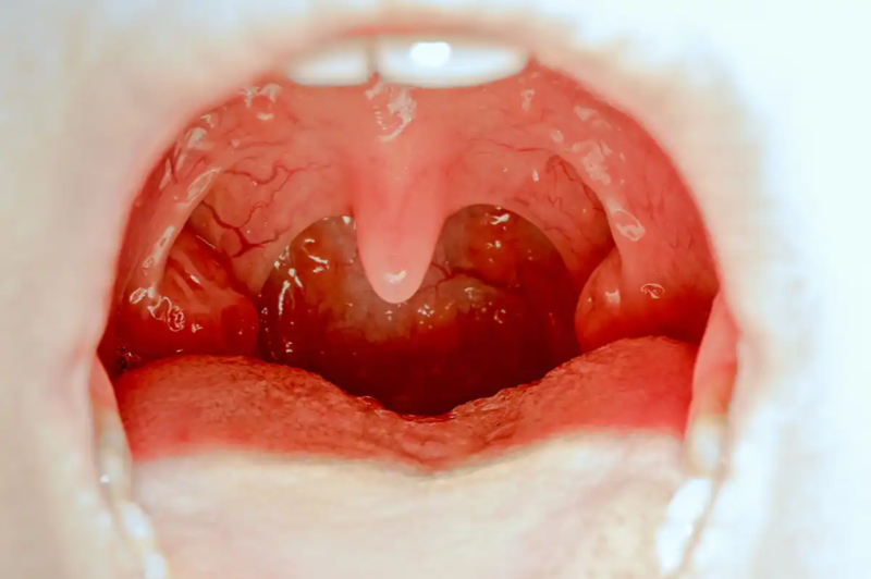 Infections associated with pus in the throat