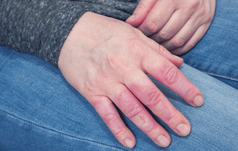 How to reduce inflammation in your fingers?
