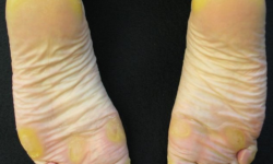 Yellow Soles Of The Feet, Why Does It Happen?
