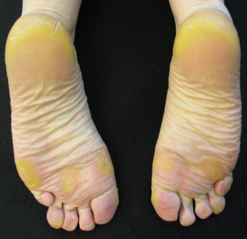 yellow-soles-of-the-feet-why-does-it-happen