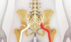 7 Medicines For Pain In The Sciatic Nerve