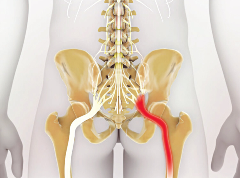 7 Medicines For Pain In The Sciatic Nerve