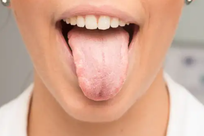 What can cause a white tongue?