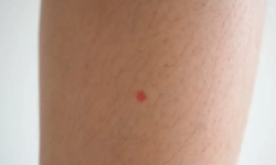 Red Spots On The Legs: What Are They Due To And What Can I Do?