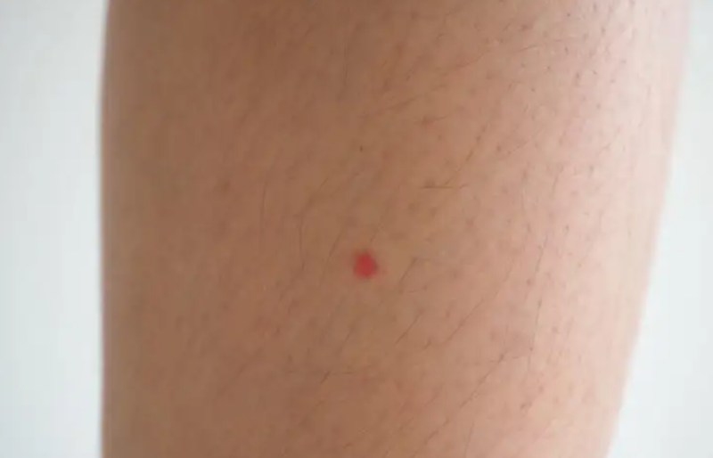 Red Spots On The Legs: What Are They Due To And What Can I Do?
