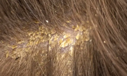 Why Do Scabs Appear On The Scalp? 13 Possible Causes