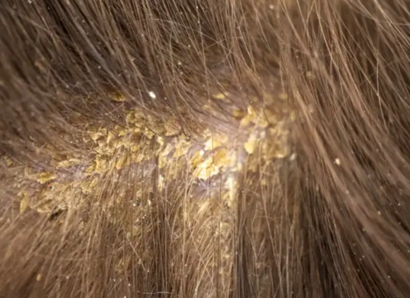 Why Do Scabs Appear On The Scalp? 13 Possible Causes